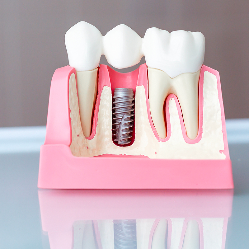 Dental Implant